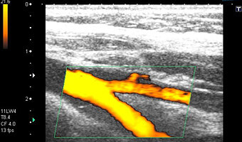 頸動脈エコー検査